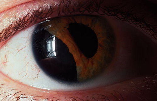 Traumatic iridodialysis. The iris has pulled away from the ciliary body as a result of blunt trauma.