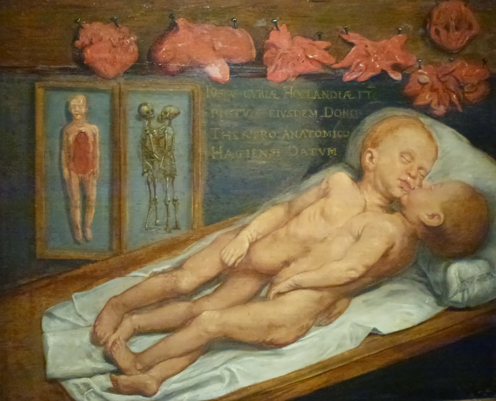 Corpses of Siamese twins, Everard Crijnsz. van der Maes, 1630, The Hague Historical Museum