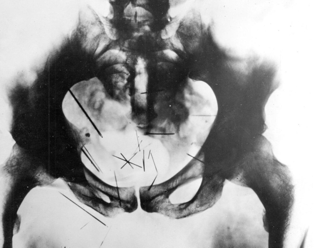 albert-fish-x-ray